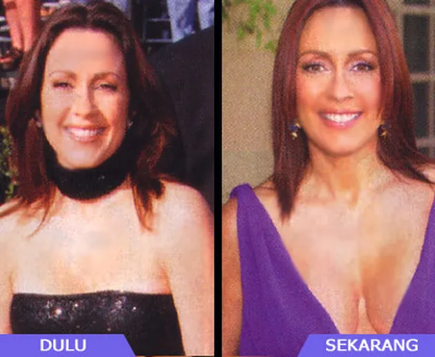 Selebritis dan Operasi Payudara