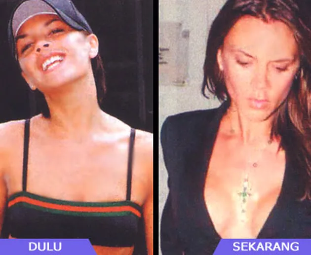 Selebritis dan Operasi Payudara