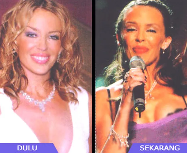 Selebritis dan Operasi Payudara