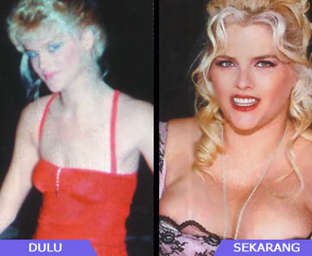 Selebritis dan Operasi Payudara