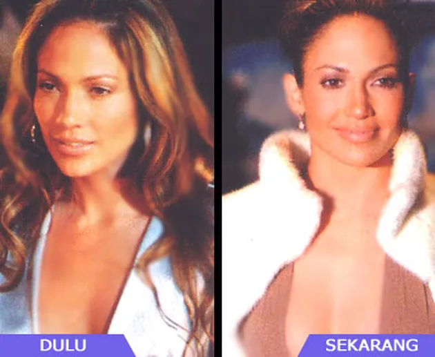 Selebritis dan Operasi Payudara