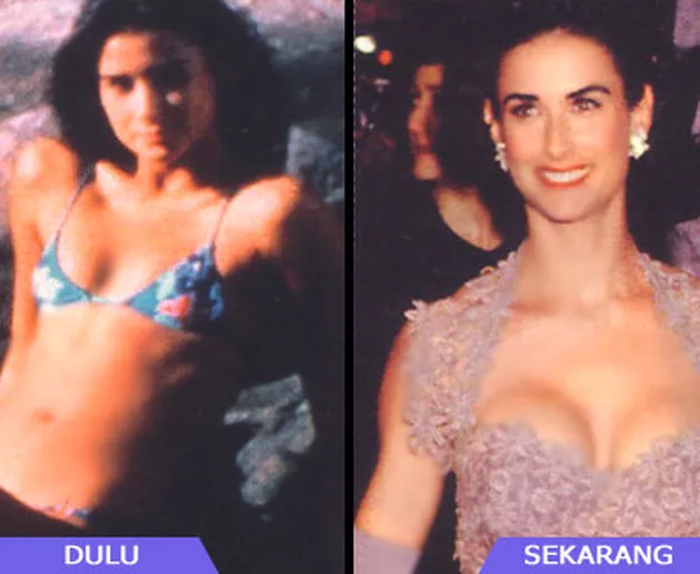 Selebritis dan Operasi Payudara