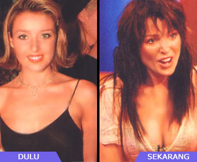 Selebritis dan Operasi Payudara