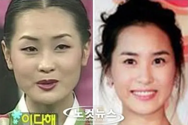 Seleb Korea Operasi Plastik