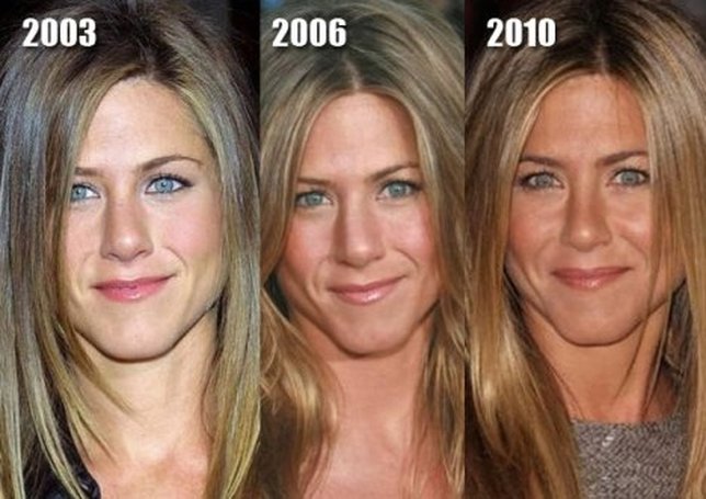 Transformasi hidung Jennifer © istimewa