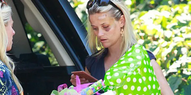 Ouch! Reese Witherspoon Luka Lebam Pasca Tabrakan