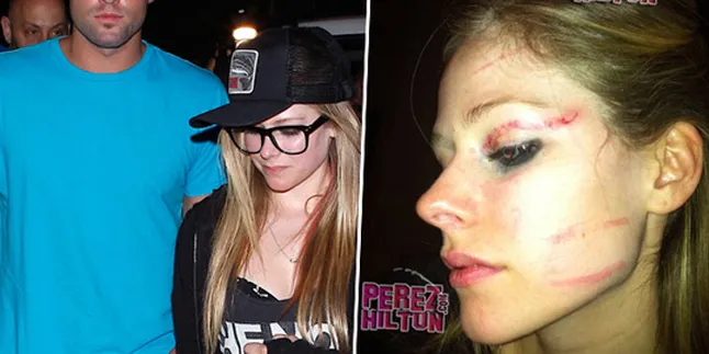 Ini Dia Wajah Babak Belur Avril Lavigne!