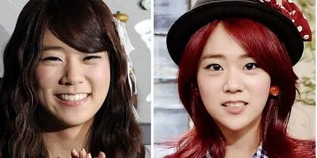 Seung Yeon KARA Lakukan Operasi Plastik?