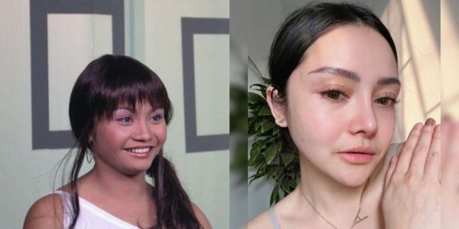 16 Transformations of Artists Before and After Nose Surgery, Some Become Addicted