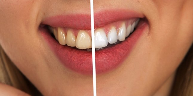7 Easy Ways to Whiten Teeth, Without Expensive Costs