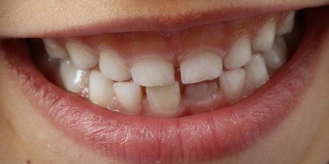 7 Ways to Naturally Treat Swollen Gums, Easy and Can Be Done Yourself