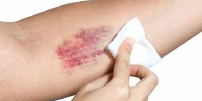 7 Ways to Quickly Treat Bruises, Easy to Practice