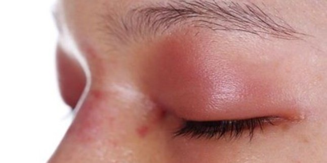 7 Easy and Quick Ways to Overcome Swollen Eyes, Can Use Natural Ingredients