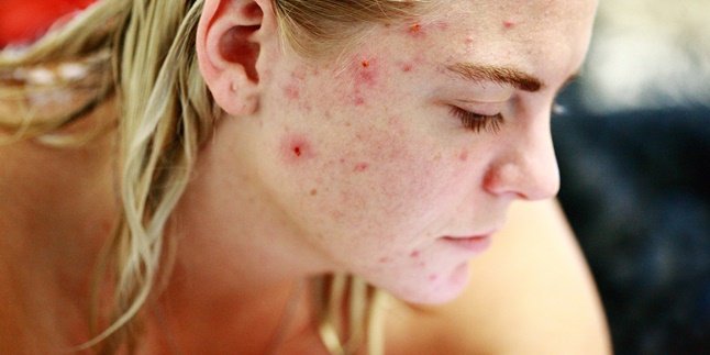 7 Ways to Get Rid of Acne Scars, Restore Smooth Skin