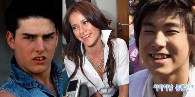 7 Selebritis Ini Melakukan Operasi Gigi