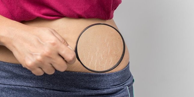 9 Common Causes of Stretch Marks on the Body and How to Deal with Them