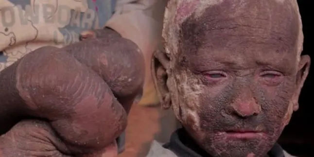 Alami Penyakit Langka, Bocah Ini Berubah Jadi 'Batu'