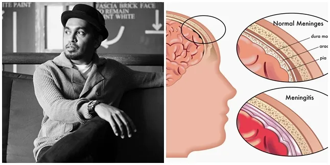 Apa Itu Meningitis? Mengenal Penyakit Yang Merenggut Nyawa Glenn Fredly Apa Itu Meningitis? Mengenal Penyakit Yang Merenggut Nyawa Glenn Fredly