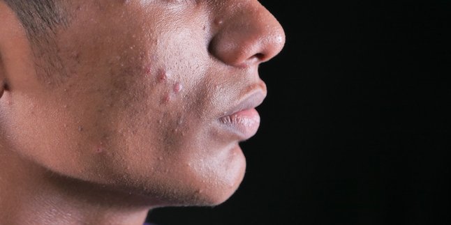 Meaning of Acne on the Nose According to Primbon, Also Know the Symptoms of Its Emergence
