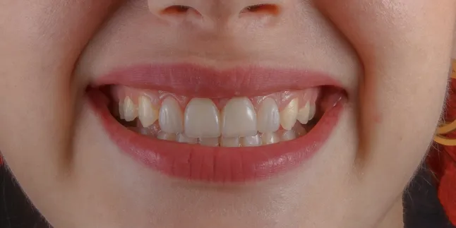 Meaning of Wobbly Lower Teeth Dreams: Interpretation and Deep Meaning