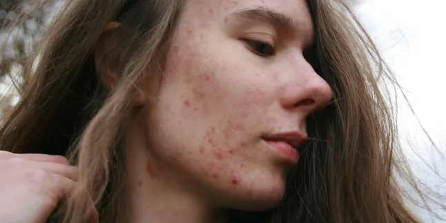 Arti Mimpi Jerawatan: Makna dan Tafsir Lengkap