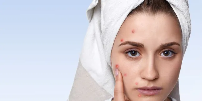 Atasi Jerawat Batu dengan Mudah, Panduan Lengkap untuk Kulit Bersih dan Sehat!