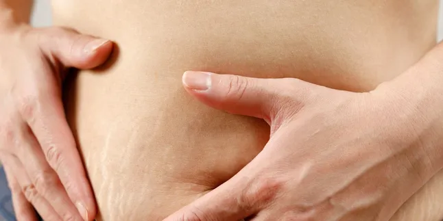Bahan Alami Ampuh untuk Menghilangkan Stretch Mark, Solusi Cantik yang Patut Dicoba!
