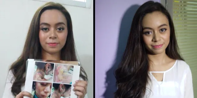 Begini Kondisi Artis Fabioli De Oliviera Pasca Disiram Air Keras