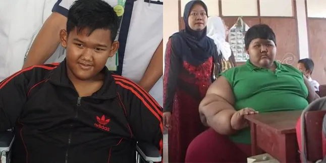 Berhasil Turunkan Berat 103 Kg, Arya Permana Jalani Operasi Pembuangan Kulit