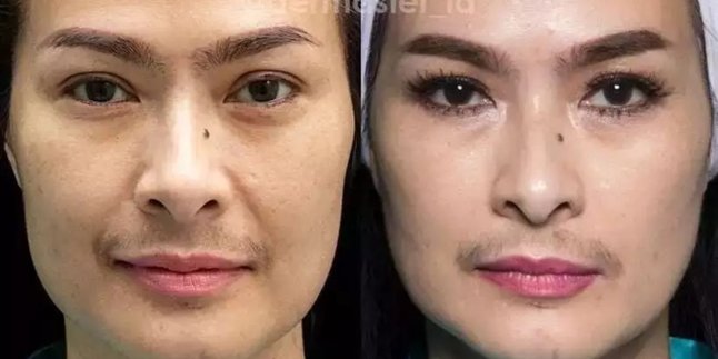Stunning, Here's a Comparison of 10 Celebrities' Faces Before and After Thread Lift