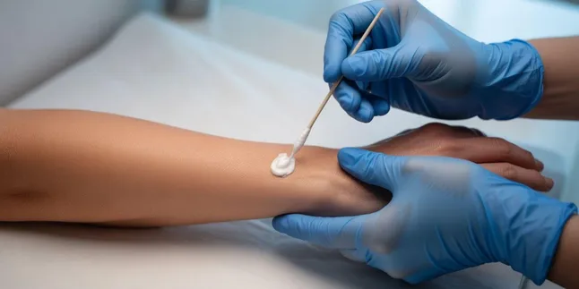 Cara Menggunakan Wart Remover Ointment dengan Benar dan Aman