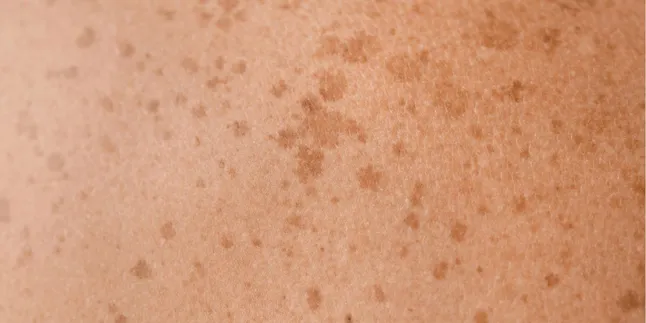 Fakta Mengejutkan, Apakah Kanker Kulit Bisa Menular Melalui Sentuhan? Simak Penjelasan Ahli!