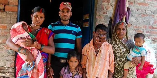 Idap Tumor Sekujur Tubuh, Pemuda Ini Jadi Seperti Monster