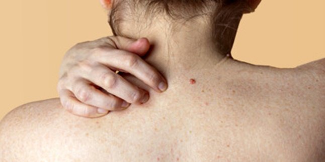 Rarely Known, Here are 6 Causes of Back Acne that are Often Overlooked