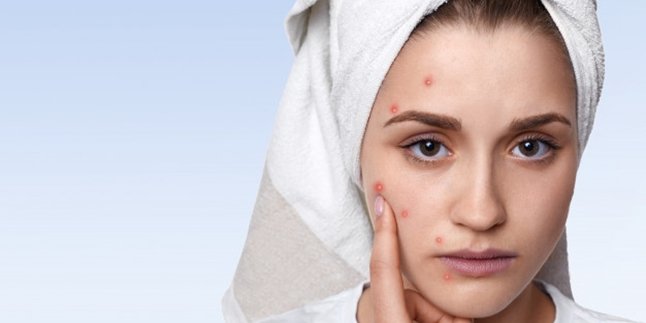 Inflamed Acne? Here's How to Dry Acne Naturally and Practically