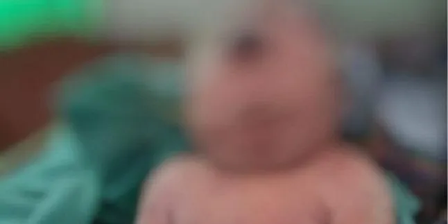 Kasus Kelahiran Langka di Indonesia, Bayi Perempuan Lahir Dengan Satu Mata