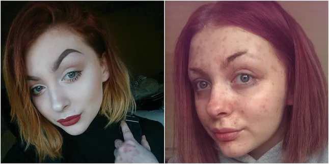 Kena Psoriasis, Cewek Ini Diputusin Pacar Saat Hapus Make Up