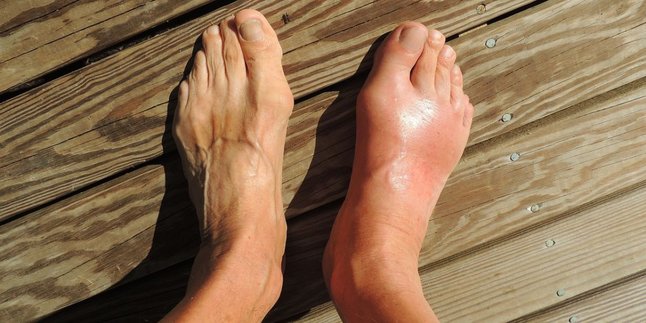 Recognize 6 Signs of Gout in the Feet, Skin Color Changes to Disturbing Swelling