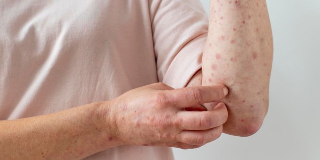 Recognize the Symptoms of Chickenpox in Children and Adults to Anticipate Early