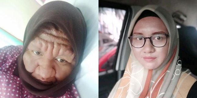 The Story of Nor Sahira Whose Face Became Like Grandma's When Pregnant, Here's the Transformation