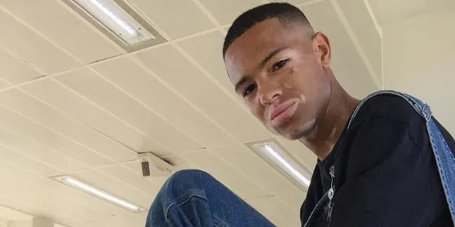 Kulit Seperti Michael Jackson, Cowok Ini Berubah Jadi Model Kece Kulit Seperti Michael Jackson, Cowok Ini Berubah Jadi Model Kece