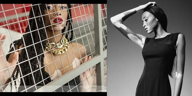 Kulit Tak Sempurna, Wanita Ini Buktikan Ia Layak Jadi Model