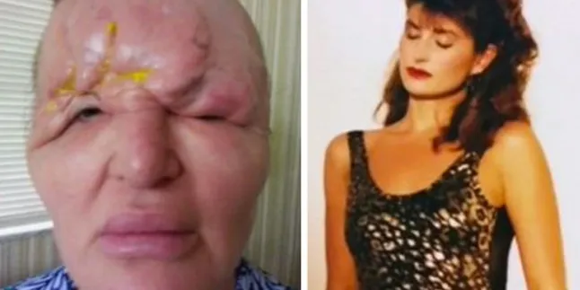 Oplas Agar Tetap Kencang, Wajah Wanita Ini Malah Luber & Bengkak