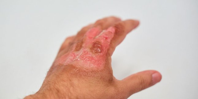 Complete Guide, Types of Burns and Effective Care Strategies to Avoid Permanent Scars!