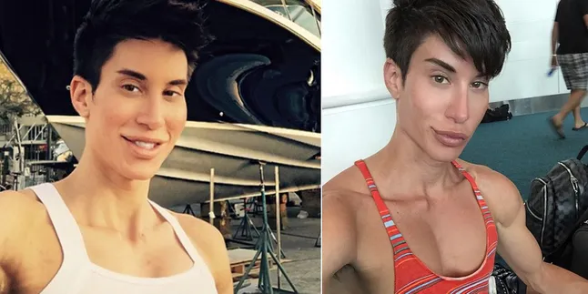 Pasca Operasi, Begini Cara Justin Jedlica Lawan Rasa Sakit Pasca Operasi, Begini Cara Justin Jedlica Lawan Rasa Sakit