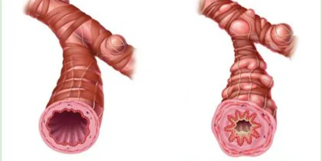 Polusi Udara dan Ancaman Tersembunyi, Waspadai Gejala Bronkitis pada Si Kecil!