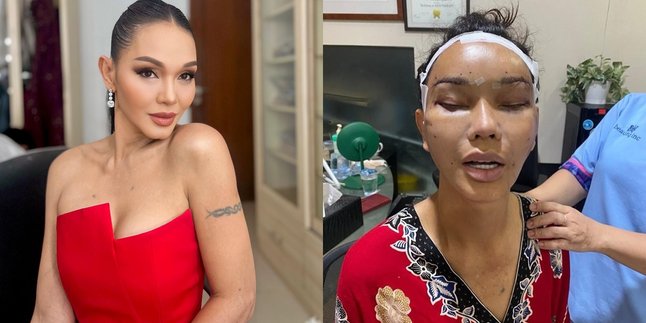 Returning to Indonesia, This is the Appearance of Bunda Corla After Plastic Surgery - Swollen Face