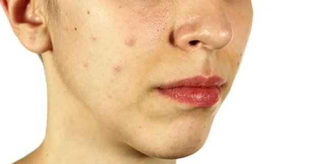 Powerful Secrets to Remove Dark Spots on Cheeks, A Complete Guide You Must Try!