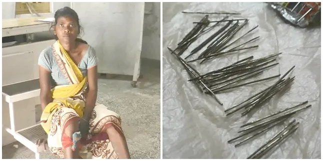 Sakit Ketika Berjalan, Ternyata Ada 70 Paku & Jarum Bersarang di Kaki Wanita Ini