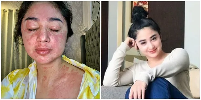 Sembuh Dari Covid, Dewi Perssik Jaga Kebersihan Hingga Mandi 5 Kali Sehari
